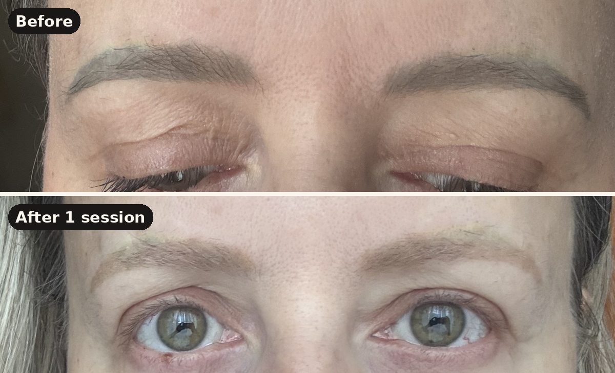 Grey eyebrow tattoo before and after one laser removal session at I Am Beautiful by Mia